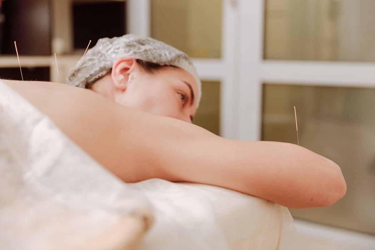 Acupuncture needles placed along a patient's upper back and shoulder on a treatment table